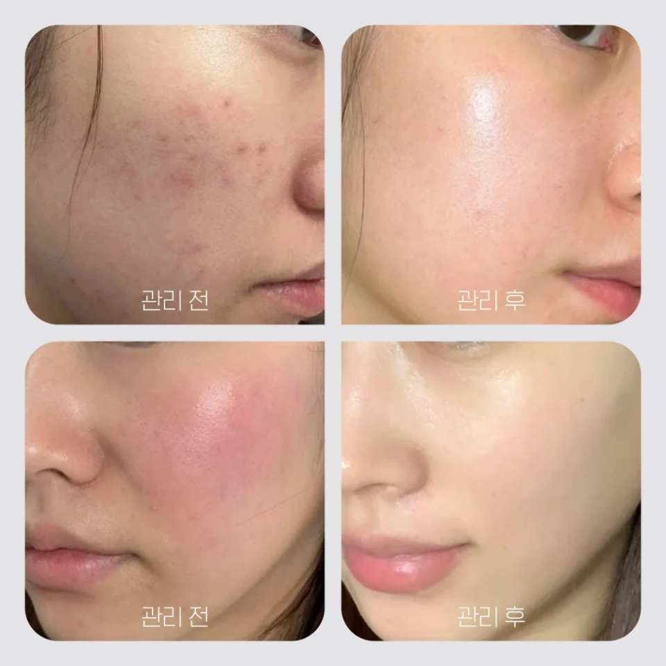 EGF 시카 재생크림 병풀 세라마이드 피부과 레이저 재생관리 점뺀후 판테놀 흔적 수분 보습